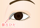 蒙古ひだのかぶさりが強く、目が小さく見える状態。