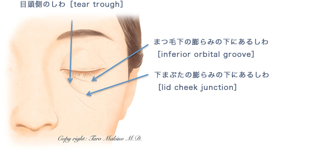 下眼瞼経結膜ハムラ法