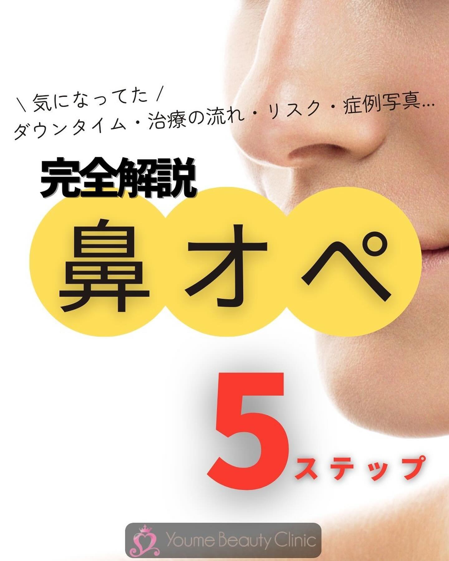 皆様こんにちわ♪
ゆめビューティークリニックです☺️

今回は【鼻フル整形】の症例をアップします💖

行ったオペはこちらです💁‍♀️
・鼻背＋眉間プロテーゼ
・鼻尖形成＋縮小
・鼻翼縮小（外側）
・鼻翼基部プロテーゼ

◾️当院での施術の特徴
⭐️鼻尖形成でも鼻中隔延長並の効果が出る
⭐️肋軟骨の採取は不要です
⭐️鼻尖縮小のみでも鼻先の細さが出せる

◾️施術内容
・鼻尖形成　¥440,000
耳介軟骨を好みのデザインに合わせて鼻先部分に移植することで理想の鼻の形に形成します。

・鼻尖縮小 ¥330,000
鼻先の余分な脂肪を除去し鼻翼軟骨を左右から寄せ、糸で縫い合わせることで細くスマートな鼻先にします。

・鼻尖形成＋鼻尖縮小　¥660,000

・鼻翼縮小 ¥275,000
小鼻の皮膚を切除して鼻の穴を小さく形成します。笑った時に広がりが気になる方や鼻の穴を小さくしたい方にオススメです。

・鼻背＋眉間プロテーゼ ¥495,000
眉間から高さが出ることで、額と鼻筋がなめらかにつながり、自然でメリハリのある立体的な印象に仕上がります。

◾️対象
・団子鼻が気になる方。
・鼻尖を高くしたい方。
・鼻尖に高さが欲しい方。
・鼻先をツンとしたい方。
・アップノーズにしたい方。　　　
・小鼻の広がりが気になる方。
etc...

◾️リスク
痛み、腫れ、左右差、違和感、後戻りなど。
ダウンタイムは個人差がございます。

【当院が選ばれる理由】　
経験豊富なドクターによる施術❗️
鼻中隔延長術レベルの仕上がり❗️
充実のアフターケア❗️

是非お問い合わせお待ちしております💖
⁡
⁡
⬛︎⬜︎youmebeauty clinic⬜︎⬛︎
ゆめビューティークリニック
美容外科・美容皮膚科
⁡
ホームページ
https://yumebeauty.com/
⁡
アクセス
福岡県久留米市新合川1-3-30
ゆめタウン久留米　2F クリニックモール
⁡
🕙10:00〜18:00 
☎️0120313170 ⭐️予約制

#ゆめビューティークリニック #ゆめタウン久留米 #久留米 #美容外科 #美容整形 #美容皮膚科 #美容垢と繋がりたい #美容オタク #整形垢さんと繋がりたい #プチ整形 #鼻整形 #鼻尖形成 #鼻中隔延長 #鼻ヒアルロン酸 #鼻整形ダウンタイム #鼻翼縮小 #鼻尖形成plus #鼻プロテーゼ #プロテーゼ #鼻が低い #鼻ぺちゃガール #鼻が低い #プロテーゼ #eライン #eラインが欲しい #鼻筋 #鼻筋矯正