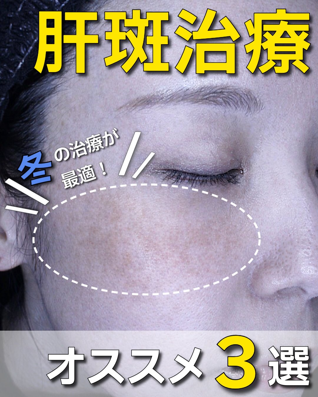 皆様こんにちは😊
ゆめビューティークリニックです🎀

@youmebeautyclinic

＼肝斑治療、何を選ぶ？／ おすすめの治療を【3つ】厳選しました✨

肝斑は刺激に弱く、 強すぎる治療は逆効果になることもあるため “やさしく・継続的に”が大切です🌿

🔹 レーザートーニング 低出力レーザーで、肝斑を刺激せずに少しずつ改善。 肝斑治療の基本となる定番治療。

🔹 ポテンツァ（肝斑モード） マイクロニードル×高周波で炎症を抑えながらアプローチ。 トーニングで改善しきれない肝斑にも◎

🔹 メソナJ 有効成分を肌の奥までしっかり導入。 肝斑治療の効果を高めたい方、併用治療におすすめ。

肝斑は「自己判断」がNG🙅‍♀️ 肌状態に合わせた治療選びが重要です❗️
※肌診断の結果次第で、他の施術をご案内させていただく場合がございます

⬛︎ 料金 ⬛︎
レーザートーニング
1回　￥22,000
3回　￥58,500
5回　￥88,000

ポテンツァ（麻酔代込み）
1回　￥33,000
3回　￥66,000
5回　￥99,000

メソナ（ホワイト）
1回　￥25,000
3回　￥68,000
5回　￥100,000

気になる方はお気軽にお問い合わせ下さいませ😊
📲0120-313-170
営業時間🕙10:00~18:00

#ゆめビューティークリニック#ゆめタウン久留米#久留米#久留米美容皮膚科#久留米美容外科福岡福岡美容皮膚科福岡美容外科美容クリニック美容皮膚科美容外科美容医療肌悩みクリニック専売品医療機関専売化粧品普通肌脂性肌乾燥肌ニキビ肌肝斑肝斑治療シミレーザートーニングポテンツァメソナJメソナ