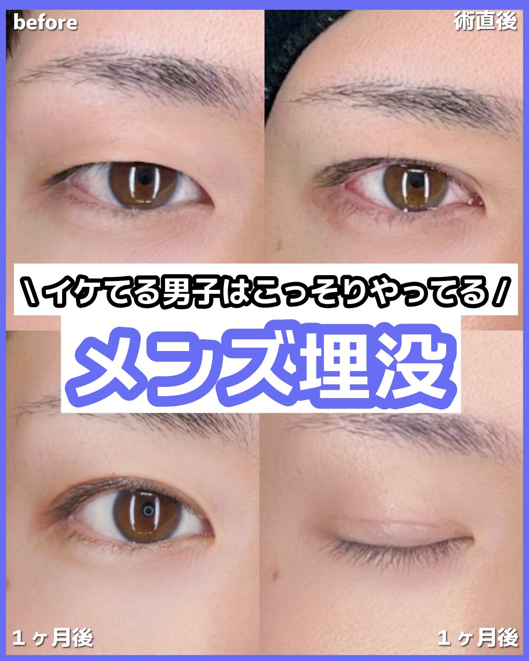 皆さまこんにちは😊
ゆめビューティークリニックです🍒

@youmebeautyclinic
⁡
誰しもこんな風になってみたい❕
そんな理想ありますよね❣️
ゆめビューティークリニックでは
お客様の希望を一人一人丁寧にお伺いして
どんなデザインが似合うか丁寧にカウンセリングしてまいります🥰

⁡
◾️施術内容
・インフィニティループ
傷が1箇所で済むことや、癒着が期待できるため長持ちすることが強みのループ法です。

◾️こんな方にオススメ
・二重の幅を広くしたい方
・傷跡の目立たない施術がしたい方
・なるべく長持ちさせたい方
・ダウンタイムが短い施術を希望している方

◾️リスク
痛み、腫れ、内出血、左右左、違和感など。
ダウンタイムは個人差があります。
⁡
◾️価格
インフィニティループ　¥264,000

【当院が選ばれる理由】　
経験豊富なドクターによる施術❗️
充実のアフターケア❗️
高い患者様満足度❗️

⁡

是非お問い合わせお待ちしております💖
⁡
⁡
⬛︎⬜︎youmebeauty clinic⬜︎⬛︎
ゆめビューティークリニック
美容外科・美容皮膚科
⁡
ホームページ
https://yumebeauty.com/
⁡
アクセス
福岡県久留米市新合川1-3-30
ゆめタウン久留米　2F クリニックモール
⁡
🕙10:00〜18:00
☎️0120-313-170 ⭐️予約制

 #久留米 #美容外科 #美容整形 #美容皮膚科 #二重整形